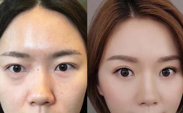 做去眼袋的手術(shù)會不會反彈?有副作用嗎?