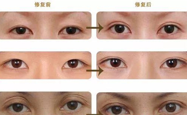 雙眼皮修復可靠嗎？什么時候做雙眼皮修復比較好？