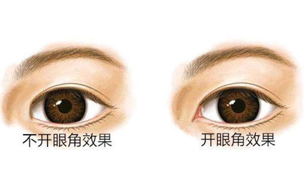 開內(nèi)眼角價格是多少?開內(nèi)眼角多久能恢復好?