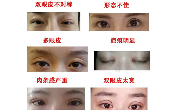 哪些情況需做雙眼皮修復(fù)？修復(fù)難度大不大?