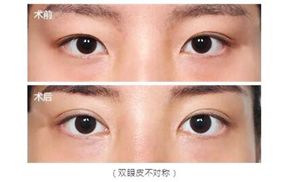 雙眼皮修復的最佳時間是什么時候?價錢貴不貴?
