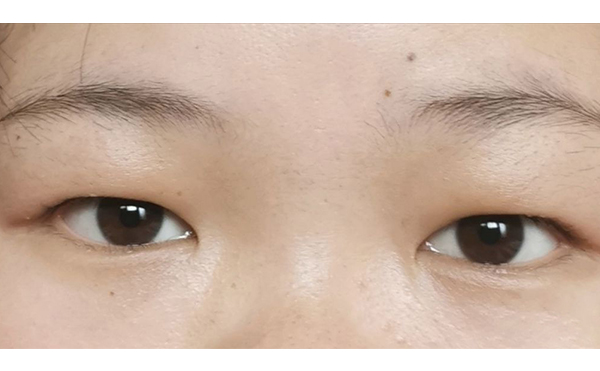 超聲波去腫眼泡效果怎樣?超聲波去腫眼泡多少錢?