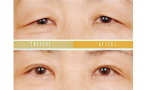 老年人怎么做三角眼矯正?術后怎么護理?