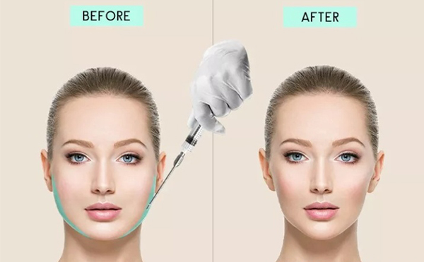 面部吸脂有哪幾種手術(shù)方法？