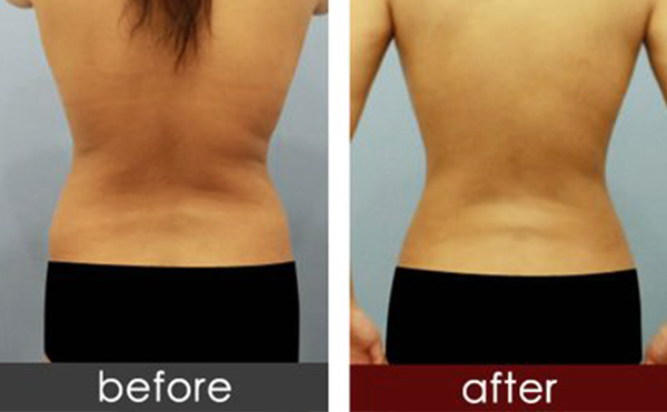 背部吸脂手術(shù)的過程是什么？
