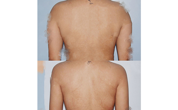 背部吸脂安全嗎？