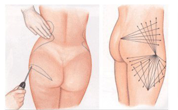 臀部吸脂的手術(shù)過程是什么？