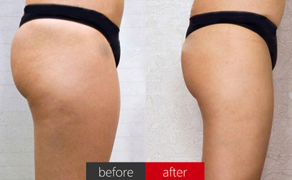 臀部抽脂術后皮膚會松弛嗎？