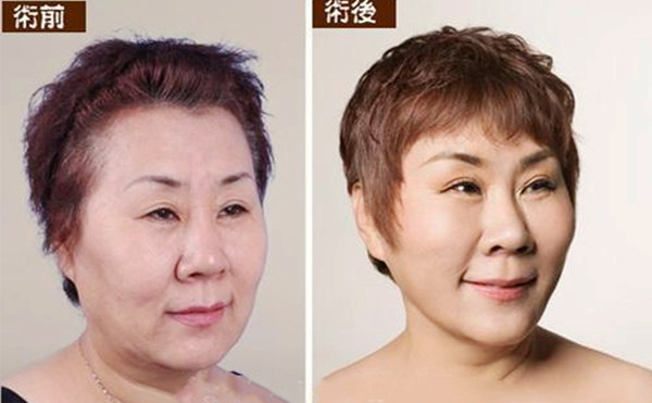 拉皮手術(shù)多久能恢復(fù)自然？