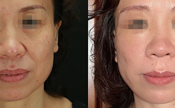 哪些人適合做拉皮手術(shù)？