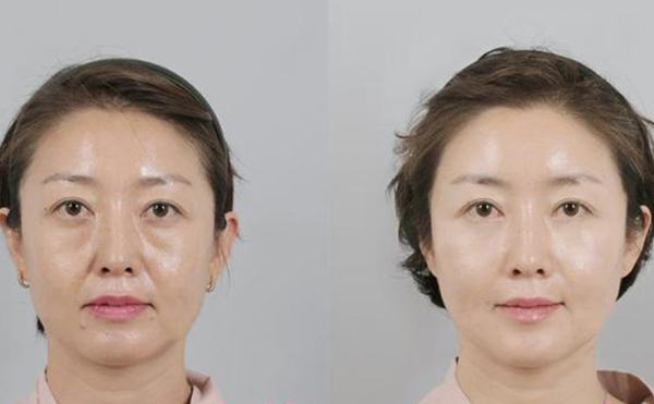 拉皮手術(shù)的過程是什么?術(shù)后需要注意什么?