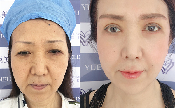 做拉皮與年齡有關(guān)嗎？