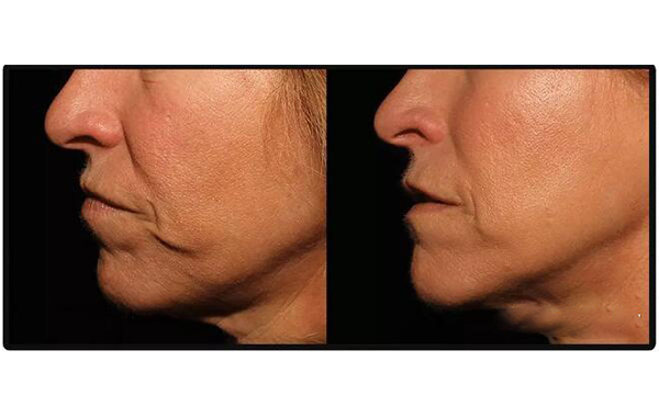 電波拉皮安全嗎？