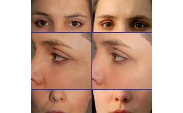 電波拉皮適合哪些人？