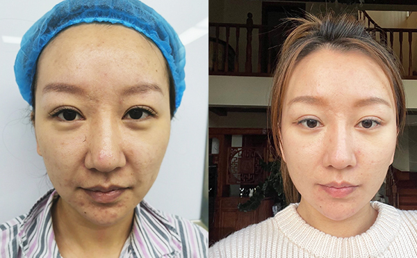 電波拉皮除皺效果能維持多久？