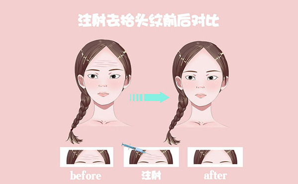 電波拉皮怎么去除抬頭紋？