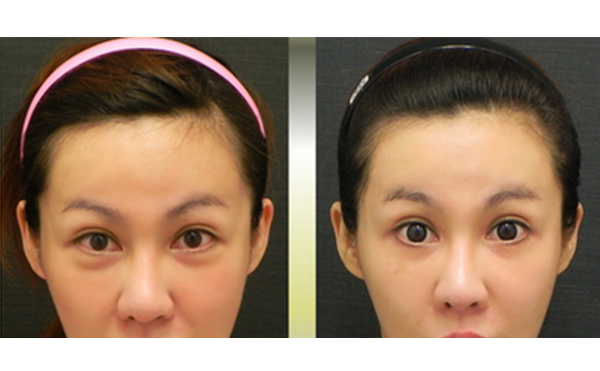 電波拉皮有副作用嗎？