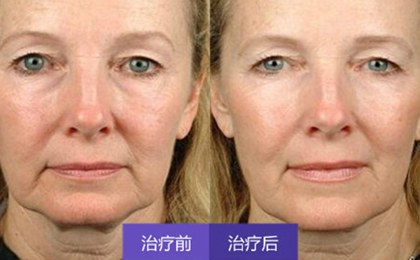 激光除皺有副作用嗎?術(shù)后怎么護(hù)理?