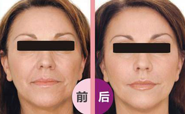 激光除皺會反彈嗎？