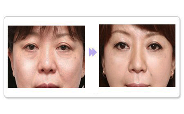 除皺針適合哪個年齡段？