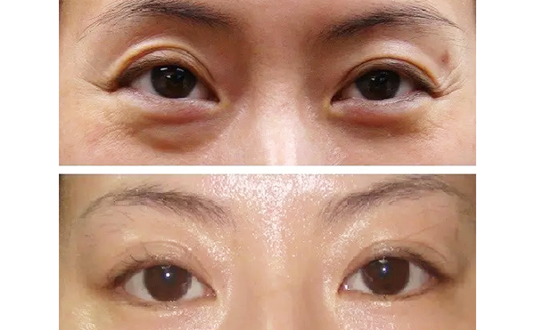 魚(yú)尾紋是怎么引起的？