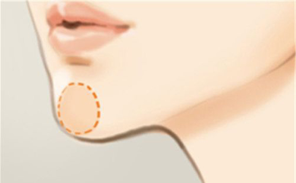 下巴整形恢復(fù)期要多久？