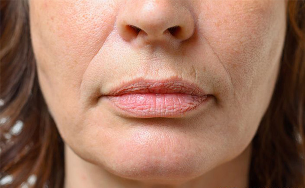 法令紋怎么形成的?怎么改善?