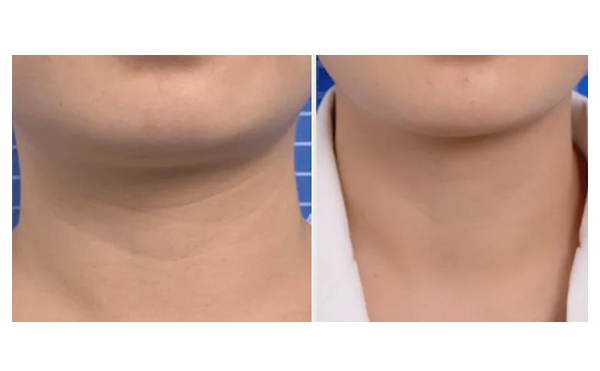 頸紋是怎么形成的？