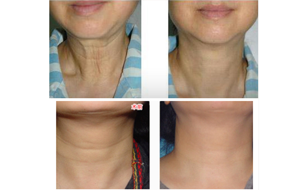 激光去除頸紋有什么優(yōu)勢？