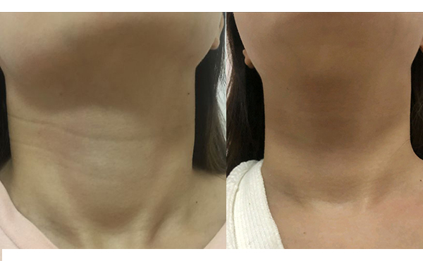 嗨體去頸紋會反彈嗎？