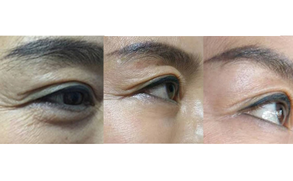 膠原蛋白除皺是什么原理？