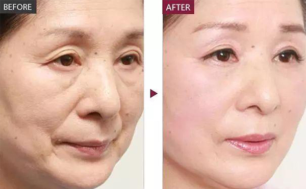 膠原蛋白除皺的適應人群？