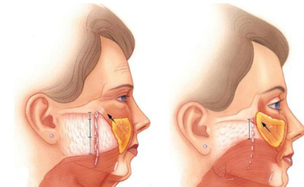 筋膜懸吊除皺是什么原理？