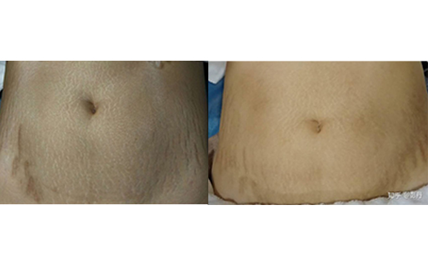 激光去妊娠紋有哪些優(yōu)勢(shì)？