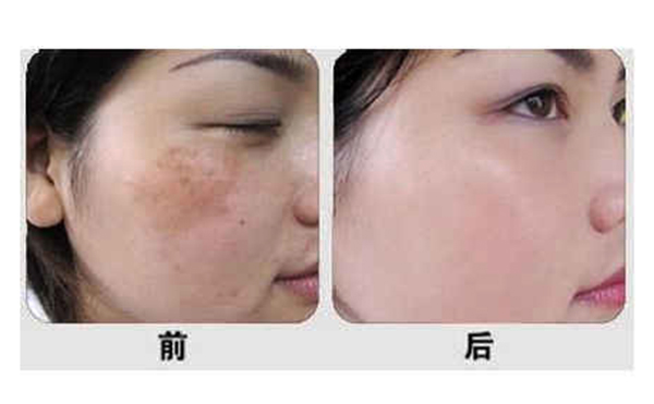 光子嫩膚有什么優(yōu)勢(shì)？