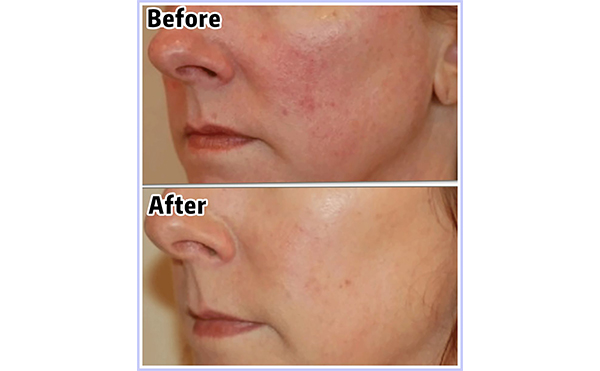 光子嫩膚會讓皮膚變薄嗎？