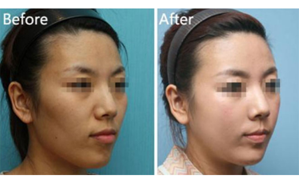 美白針一針多少錢？