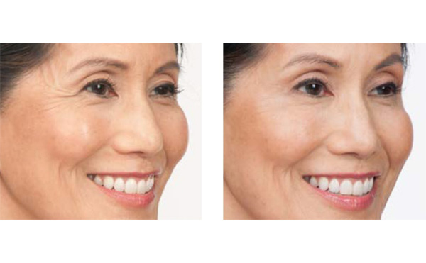 水光針適合哪個年齡段？