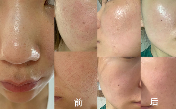 無(wú)針?biāo)庥惺裁磧?yōu)勢(shì)？