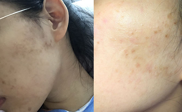 白瓷娃娃對黃皮有效嗎？