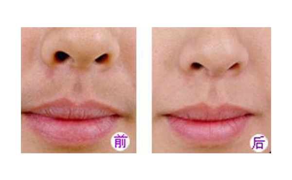 冰點脫毛好不好？