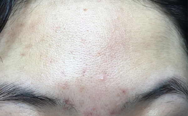 冰點(diǎn)脫毛有什么缺點(diǎn)嗎？