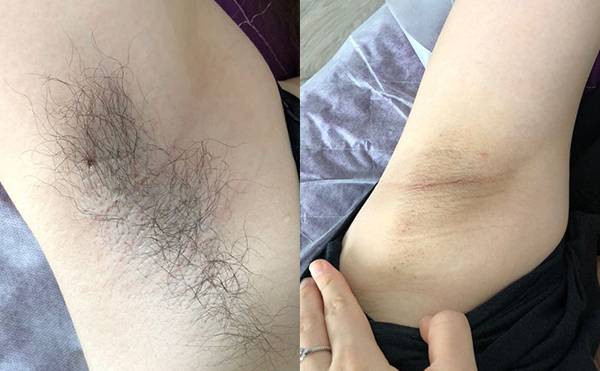 光子脫毛多少錢?價格跟哪些因素有關?