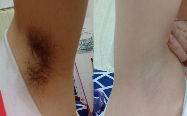 冰點脫腋毛過程是什么？