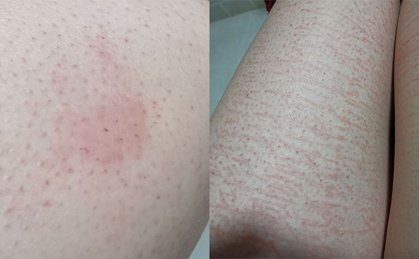 錯誤脫毛有什么后果？