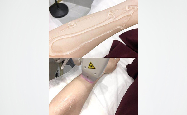 激光手臂脫毛是怎么做的？