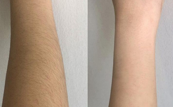 脫毛會(huì)影響新陳代謝嗎？