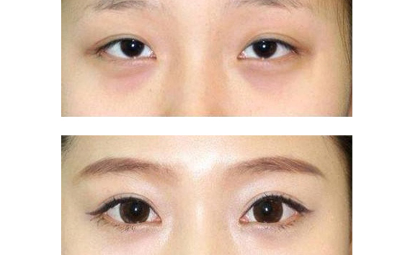 眼綜合和隆鼻可以一起做嗎？