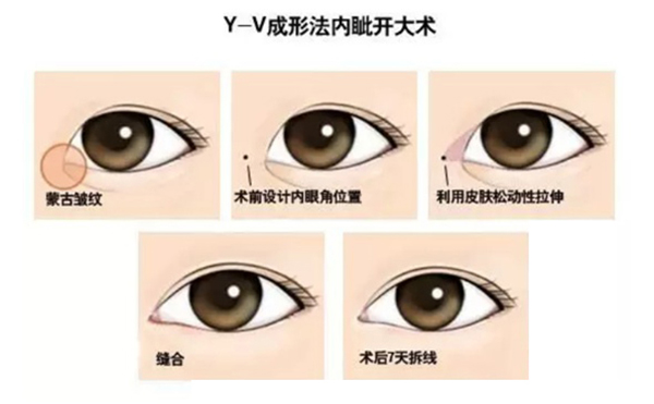 開內眼角復雜嗎?手術過程是什么?