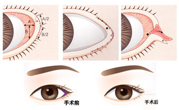 開外眼角和眼瞼下至的區(qū)別是什么?多久恢復(fù)好?